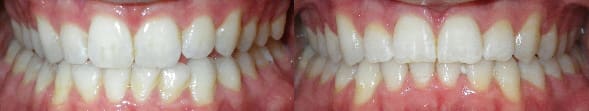 Treatment of crowding and openbite with SureSmile custom archwires