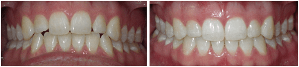 Atlanta Invisalign Wright Orthodontics