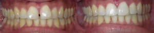 BC-Invisalign