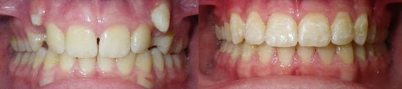 Details: Correction of crowding & spacing with SureSmile custom archwires