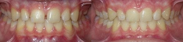 Invisalign Teen treatment of spacing