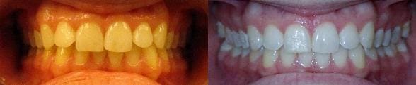 Invisalign treatment of crowding & overbite 2