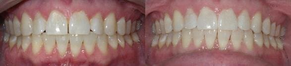 Invisalign treatment of crowding & spacing