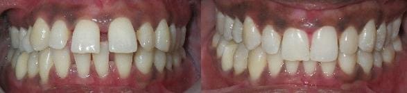 Invisalign treatment of spacing & overbite