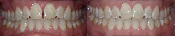 Invisalign treatment of spacing