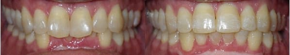 Details: Correction of crowding & deep overbite with SureSmile custom archwires