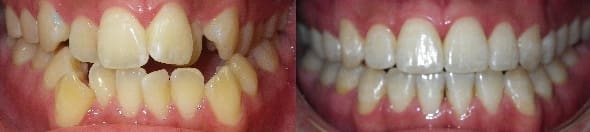 Details: Correction of Class III malocclusion, crowding, anterior & posterior crossbite with SureSmile custom archwires