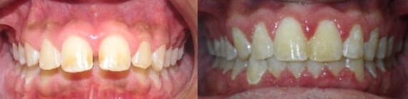 Details: Correction of spacing & severe overjet with SureSmile custom archwires