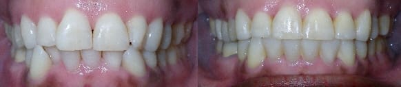 Details: Correction of crowding & anterior crossbite with SureSmile custom archwires