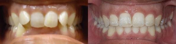Treatment of crowding, anterior crossbite & overbite with SureSmile custom wires