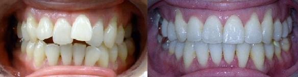 Treatment of crowding, anterior & posterior crossbite with SureSmile custom wires