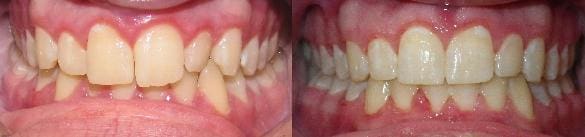 Treatment of crowding & crossbite with SureSmile custom wires
