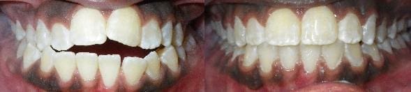 Treatment of crowding, spacing, posterior crossbite & openbite with SureSmile custom wires