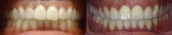 Treatment of crowding with SureSmile custom wires 2