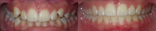 Treatment of crowding with SureSmile custom wires