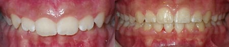 Treatment of deep overbite with SureSmile (Center)