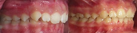 Treatment of deep overbite with SureSmile (Right)