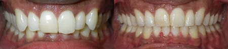 Treatment of overbite and overjet with SureSmile (Center)