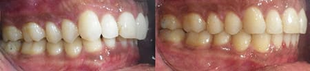 Treatment of overbite and overjet with SureSmile (Right)