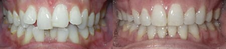 Treatment of severe crowding with SureSmile (Center)
