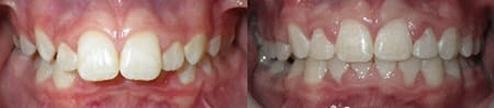 Treatment of severe overbite and overjet with SureSmile (Center)