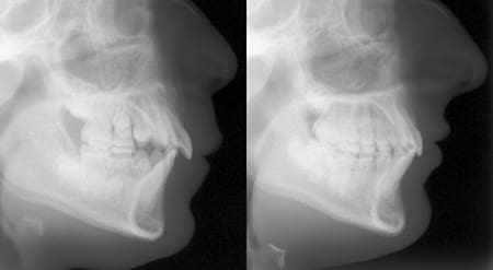 Treatment of severe overbite and overjet with SureSmile (Ceph)