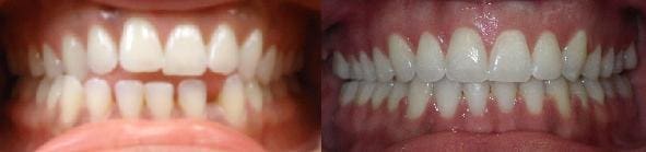Treatment of spacing, crowding, anterior crossbite & openbite with SureSmile custom wires