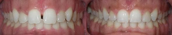 Treatment of spacing & crowding with SureSmile custom wires