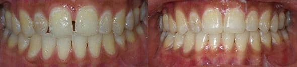 Treatment of spacing with Invisalign