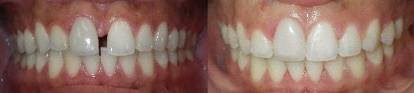 Treatment of spacing with SureSmile custom wires 1