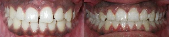 Treatment of spacing with SureSmile custom wires 2