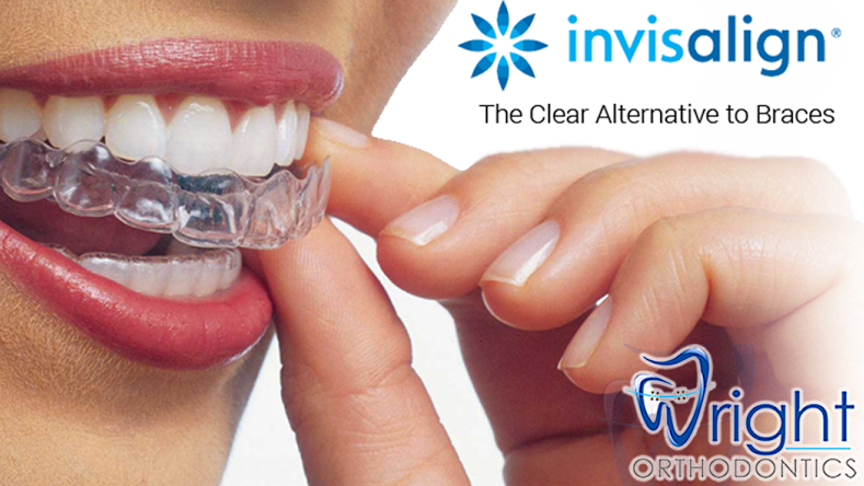 Invisalign Teen Aligners Are 84