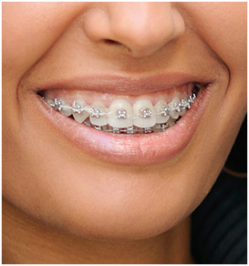 Ceramic Braces, Advantages, Costs & More