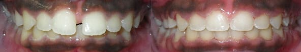 Treatment of spacing and overbite with traditional braces