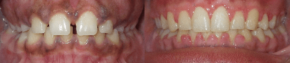 Braces Before and After Pictures Atlanta, GA