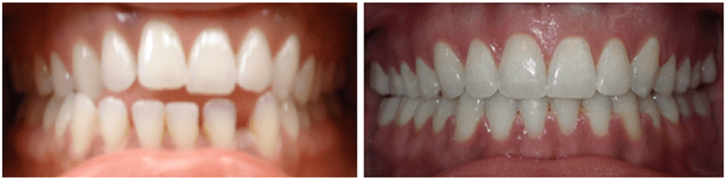 Atlanta Orthodontic Braces
