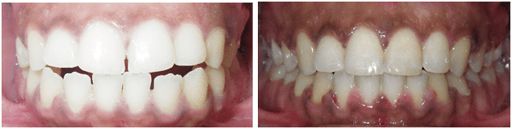 Details: Correction of upper & lower spacing, anterior crossbite & openbite with braces