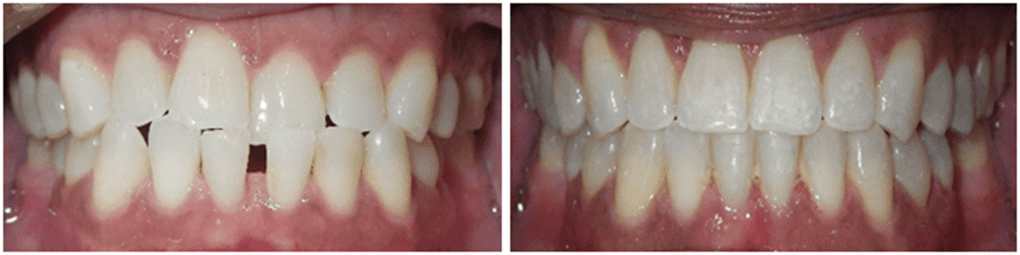 Details: Correction of upper crowding, lower spacing, anterior crossbite with braces.