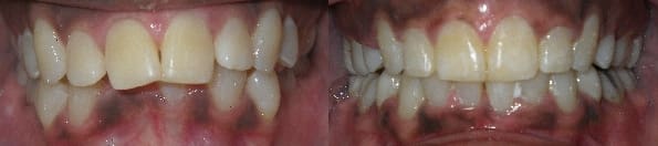 Details: Correction of crowding & severe overbite with traditional braces