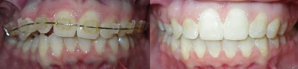Correction of canted arch with traditional archwires