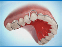 Orthodontic Retainers in Atlanta and Marietta, GA