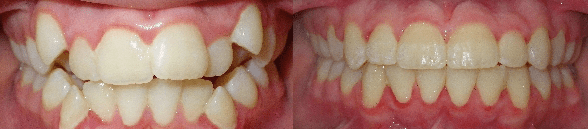 Braces Before and After Pictures Atlanta, GA