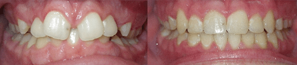 Braces Before and After Pictures Atlanta, GA