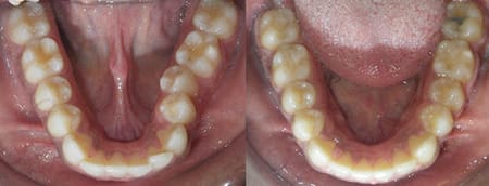 Treatment-of-crowding-with-traditional-braces
