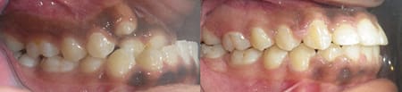Treatment of underbite with traditional braces