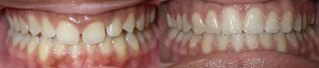Treatment-of-spacing-with-traditional-braces