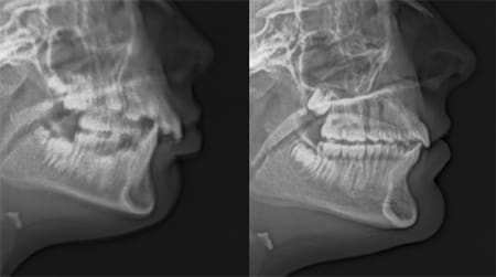 Details: Treatment of severe overjet with traditional braces.