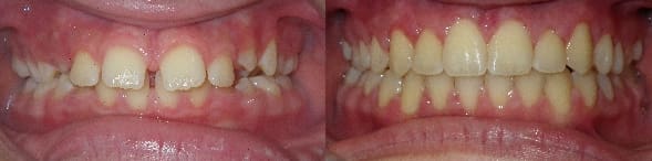 Treatment of spacing with traditional braces