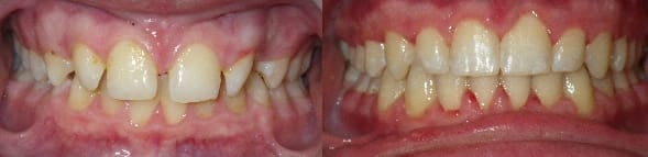 Treatment of upper spacing and lower crowding with traditional braces
