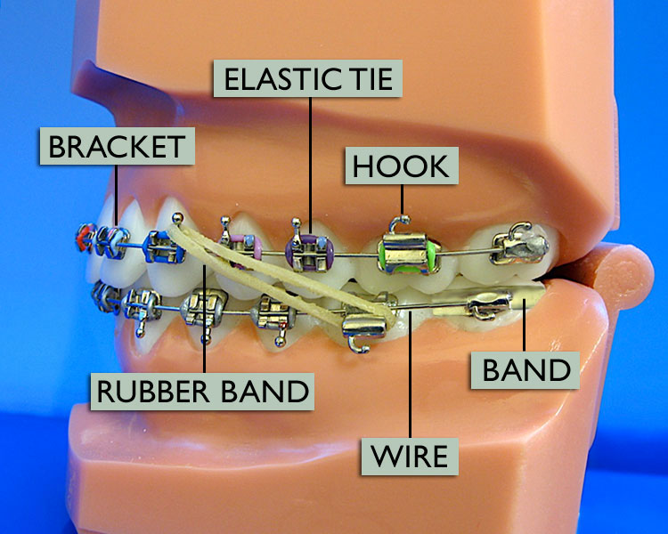 braces-diagram-wright-orthodontics-atlanta-marietta-ga